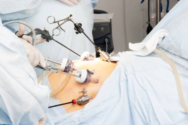 Gastrik bypass cerrahisi