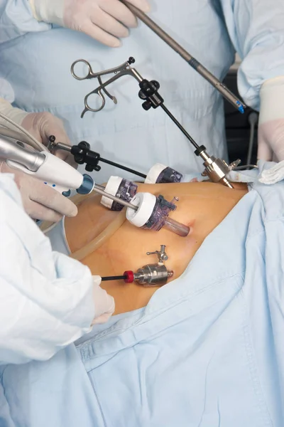 Gastric bypass-operation — Stockfoto