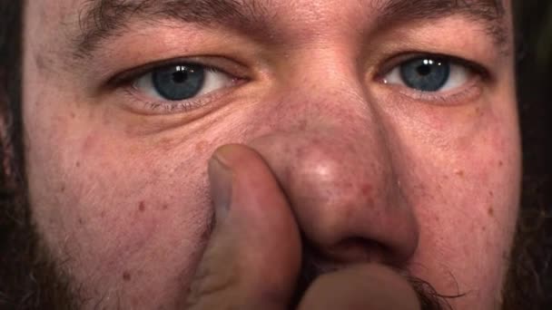 Homem Aperta Acne Nariz Gordura Sai Dos Poros Nariz — Vídeo de Stock