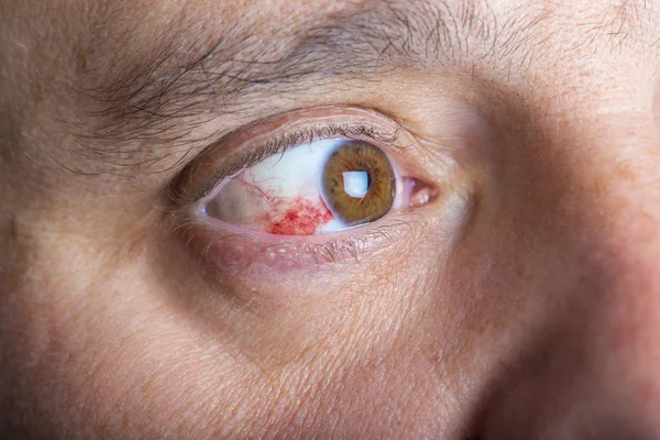 Červená bloddshot oči — Stock fotografie
