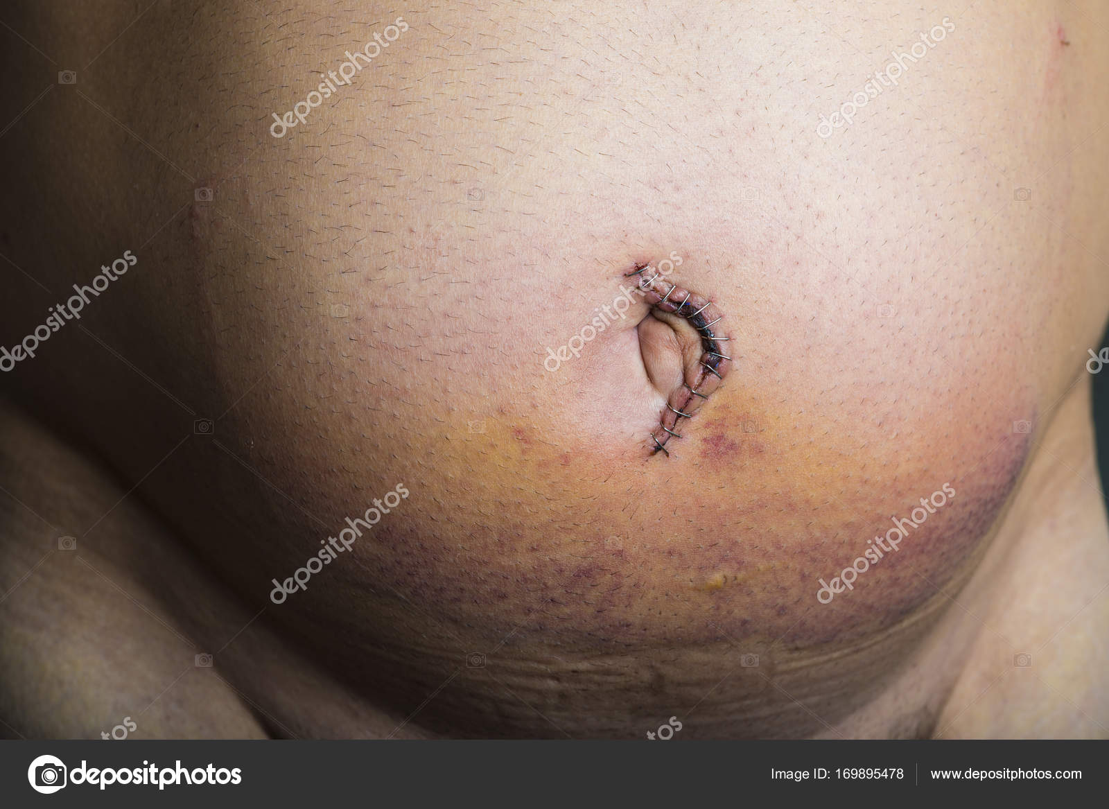 Cirugia de hernia umbilical recuperacion