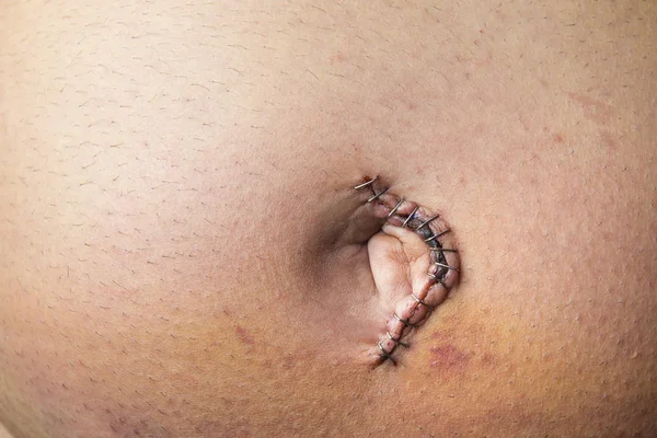Umbilical bråck reparation kirurgi — Stockfoto