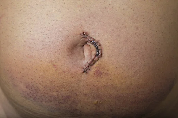 Chirurgie de réparation de hernie ombilicale — Photo