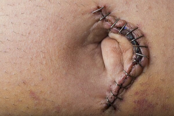 Umbilical hernia repair surgery