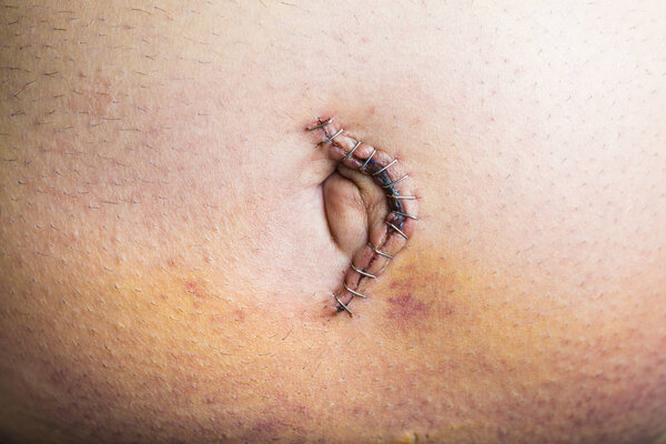 Umbilical hernia repair surgery