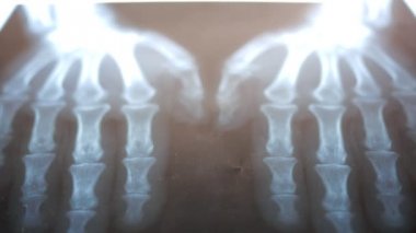 röntgeni el siyah arka plan üzerine