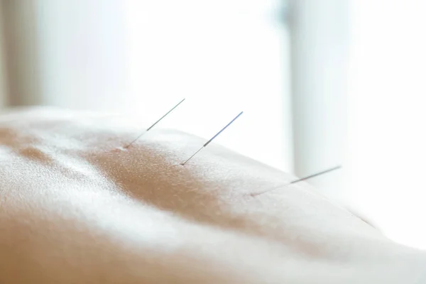 Patient mit Triggerpunktinjektionen zur Linderung von Rückenschmerzen im Physioraum. — Stockfoto