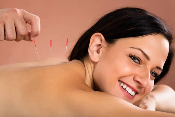 Mulher jovem recebendo tratamento de acupuntura — Fotografia de Stock