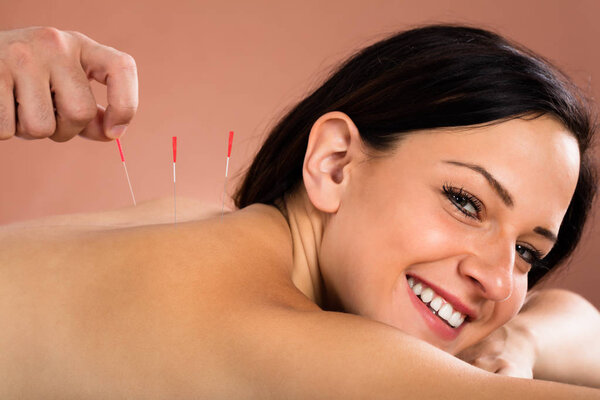 Young Woman Receiving Acupuncture Treatment 