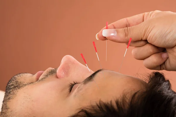 Man Receiving Acupuncture Treatment — Stock Photo, Image