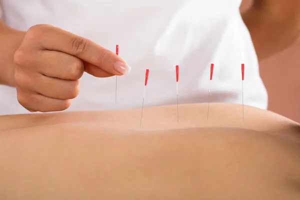 Mann erhält Akupunktur-Behandlung — Stockfoto