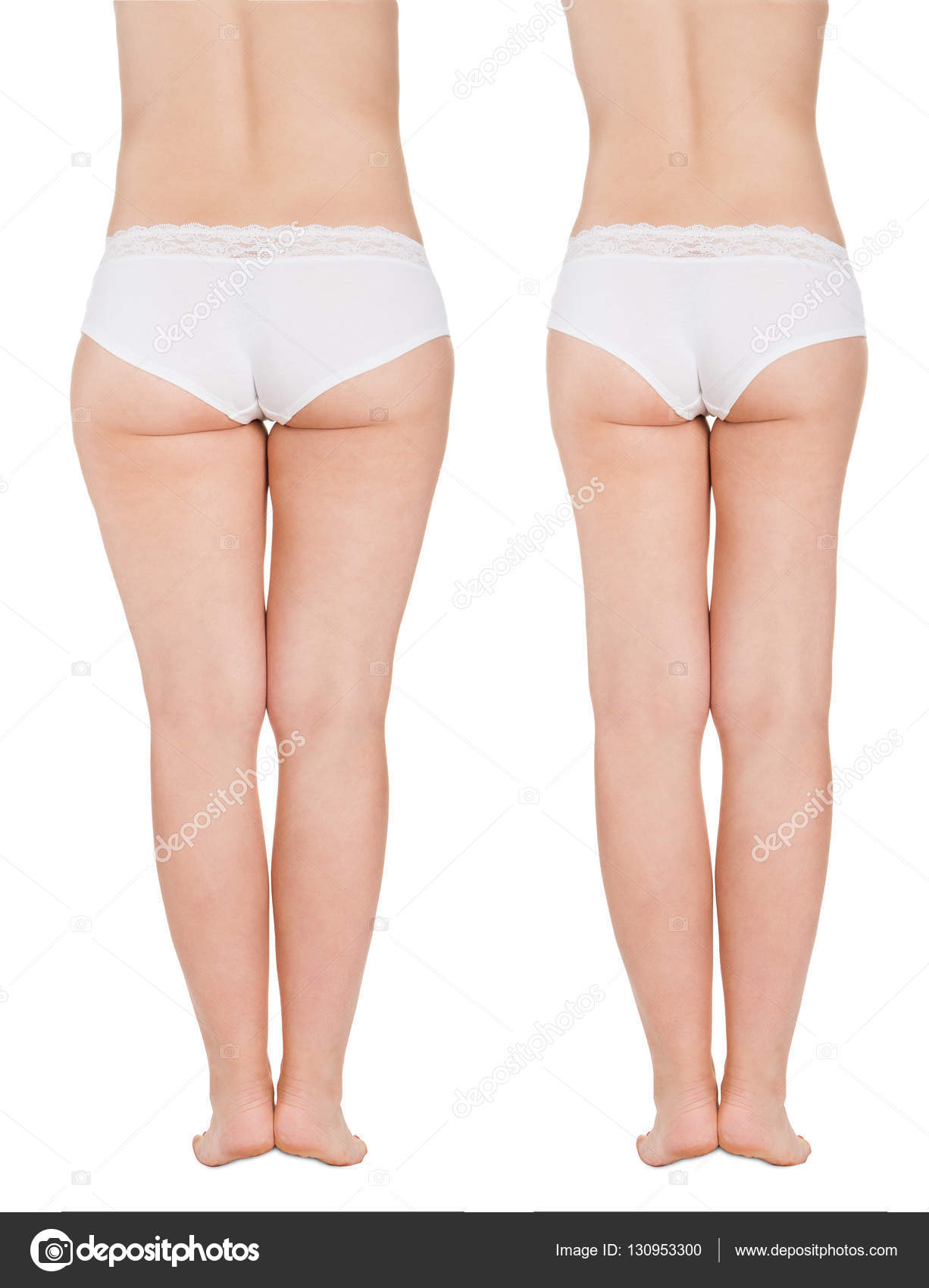 Fotos de liposuccion en muslos 37 Fotos de liposuccion en muslos 55