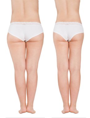 Yağ uyluk öncesi ve sonrası Liposuction