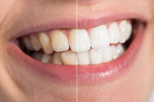 Зубы человека до и после отбеливания — стоковое фото