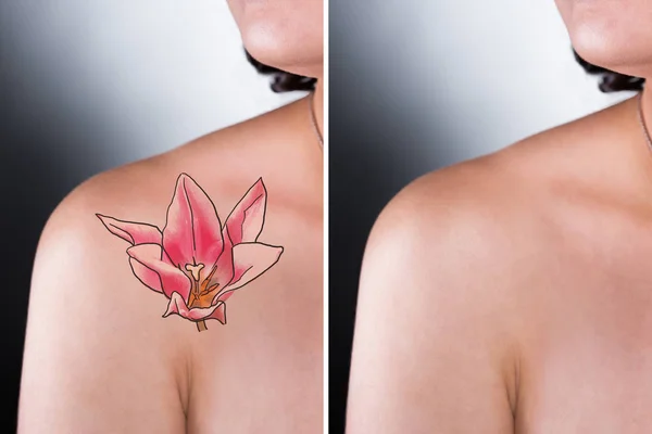 Rimozione del tatuaggio laser — Foto Stock
