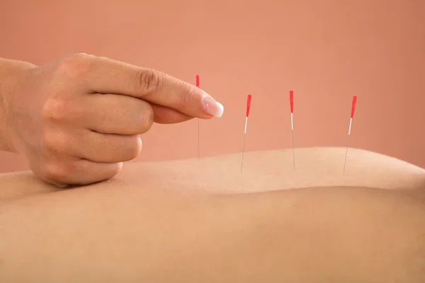 Homem recebendo tratamento de acupuntura — Fotografia de Stock