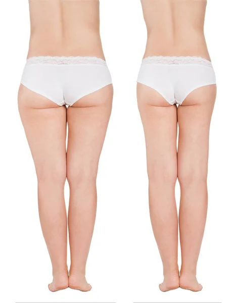 Fat Thighs Before and After Liposuction — Stock Photo, Image