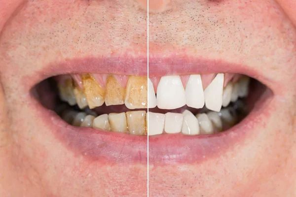 Dentes antes e depois do clareamento — Fotografia de Stock