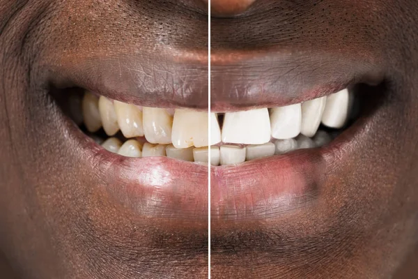 Dentes antes e depois do clareamento — Fotografia de Stock