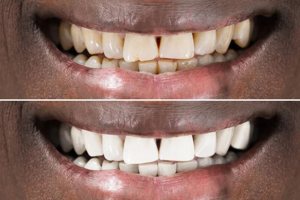 Зубы до и после отбеливания — стоковое фото
