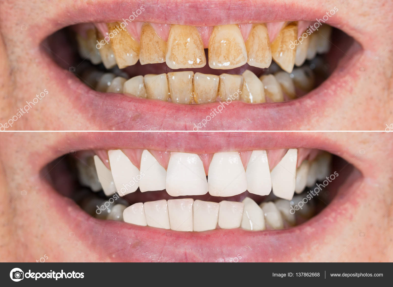 blanchiment des dents avant apres blanchiment des dents avant apres