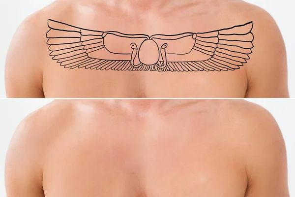 Remoção de tatuagem a laser — Fotografia de Stock