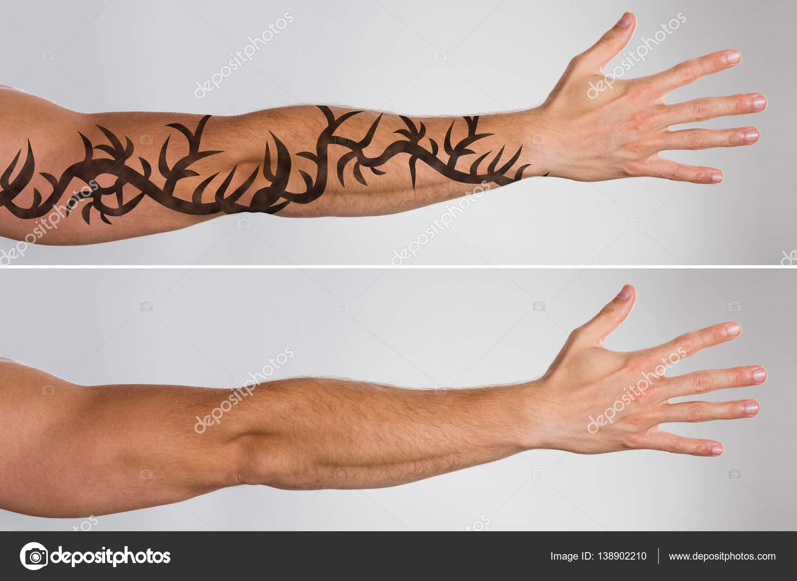 1. Laser Tattoo Removal - wide 3
