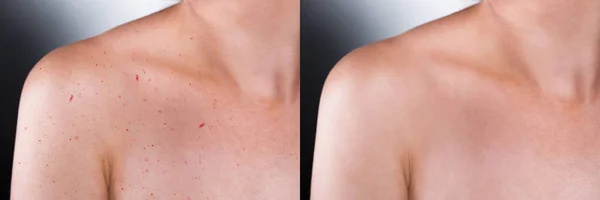 Antes y después del resultado de la piel —  Fotos de Stock