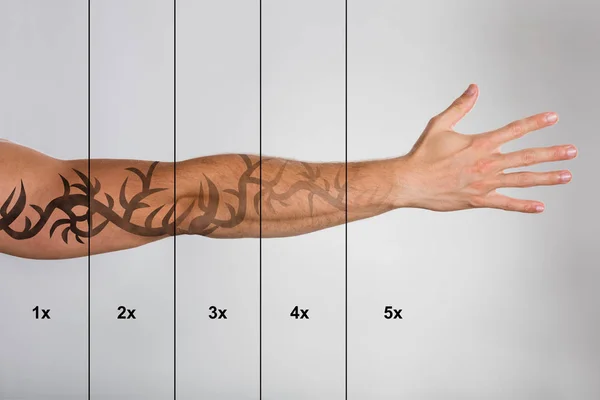 Tattoo removal Stock Photos, Royalty Free Tattoo removal Images | Depositphotos Tattoo removal Stock Photos, Royalty Free Tattoo removal Images | Depositphotos