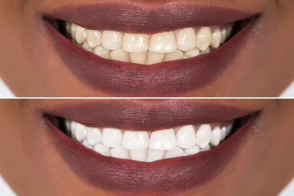 Zębów przed i po wybielanie — Zdjęcie stockowe