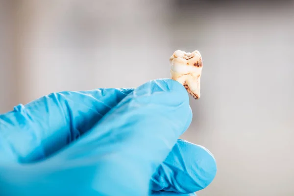 Dentista sosteniendo el diente de caries — Foto de Stock