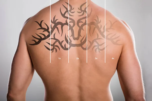 Laser tattoo removal Stock Photos, Royalty Free Laser tattoo removal Images | Depositphotos Laser tattoo removal Stock Photos, Royalty Free Laser tattoo removal Images | Depositphotos
