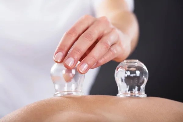 Therapeut geeft Cupping behandeling — Stockfoto