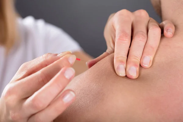 Kişi koyarak akupunktur iğnesi — Stok fotoğraf