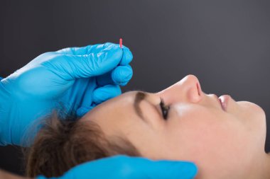 Kişi koyarak akupunktur iğnesi 