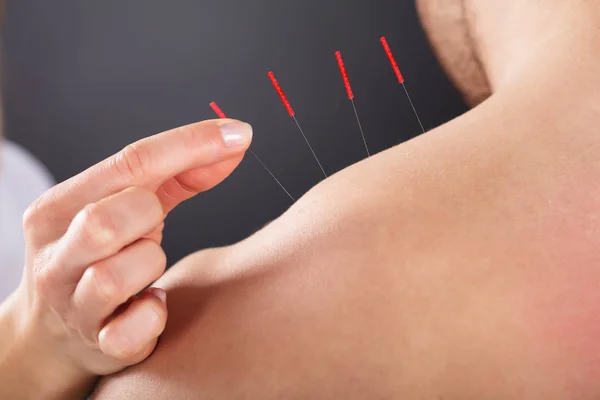 Female Hand Putting Acupuncture Needle — Stock Photo, Image