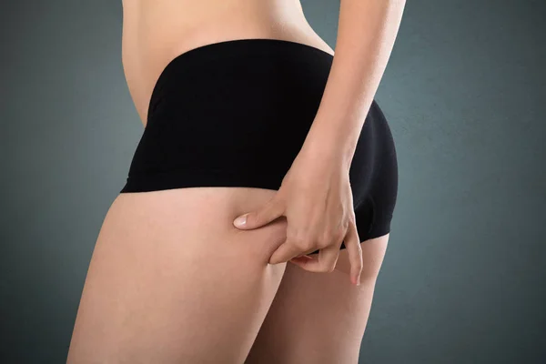 Comprobación de celulitis femenina — Foto de Stock