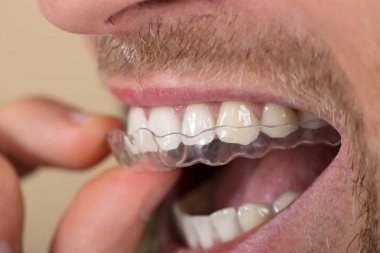Adam Holding şeffaf Aligner 