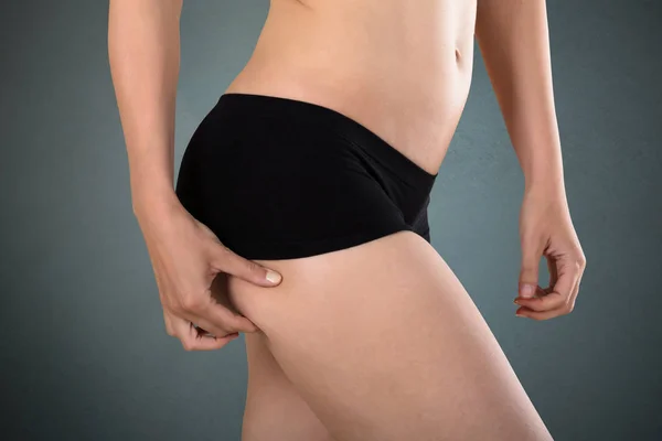 Comprobación de celulitis femenina — Foto de Stock