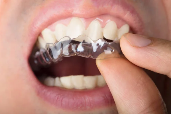 Adam Aligners diş ayarlama — Stok fotoğraf