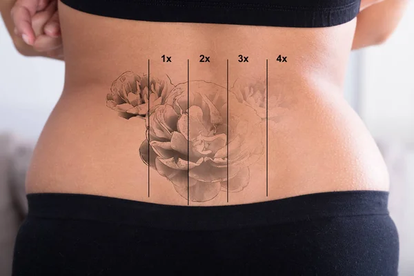 Penghapusan Tattoo Laser — Stok Foto