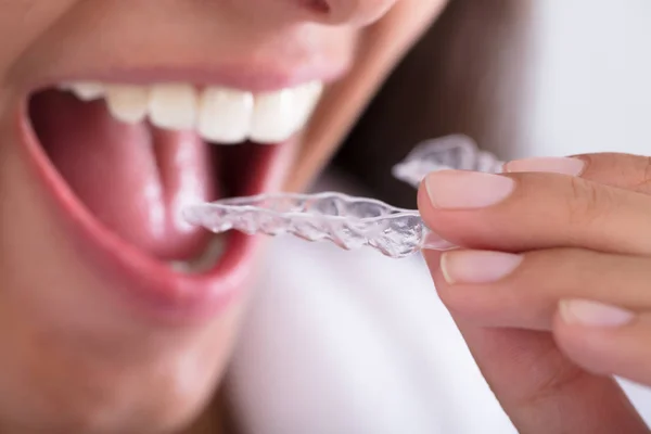 Mujer poniendo alineador transparente — Foto de Stock