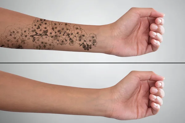 Enlèvement de tatouage laser — Photo