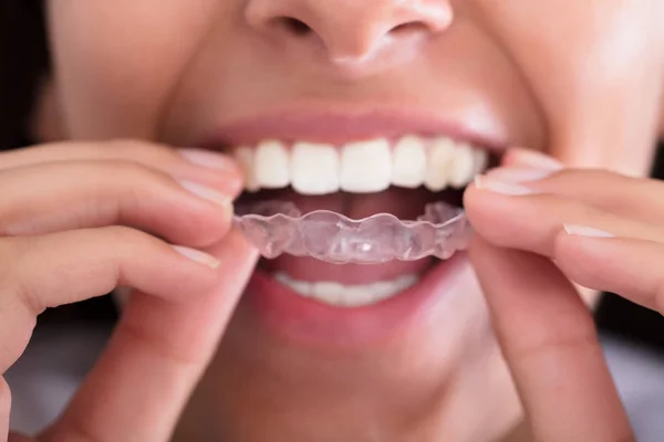 Woman Putting Transparent Aligner — Stock Photo, Image