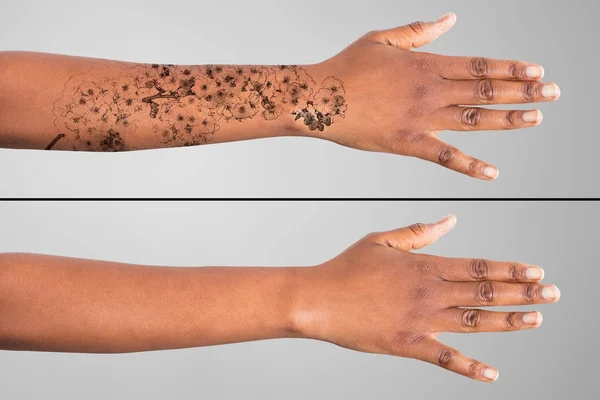 Удаление татуировок на женских руках — стоковое фото