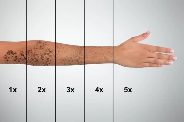 Rimozione del tatuaggio sulla mano della donna — Foto Stock
