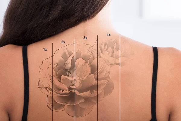 Laser tatuering borttagning på kvinnan tillbaka — Stockfoto