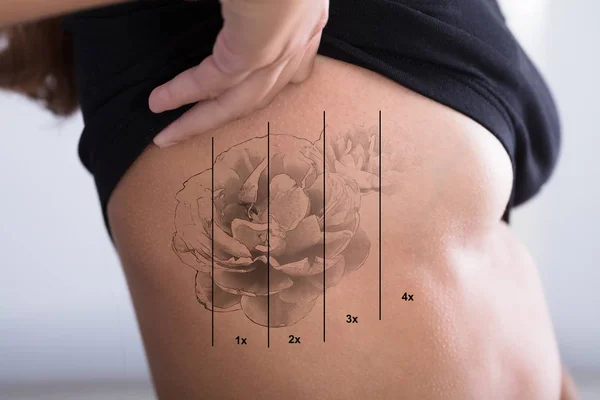 Удаление татуировки на женском ребре — стоковое фото