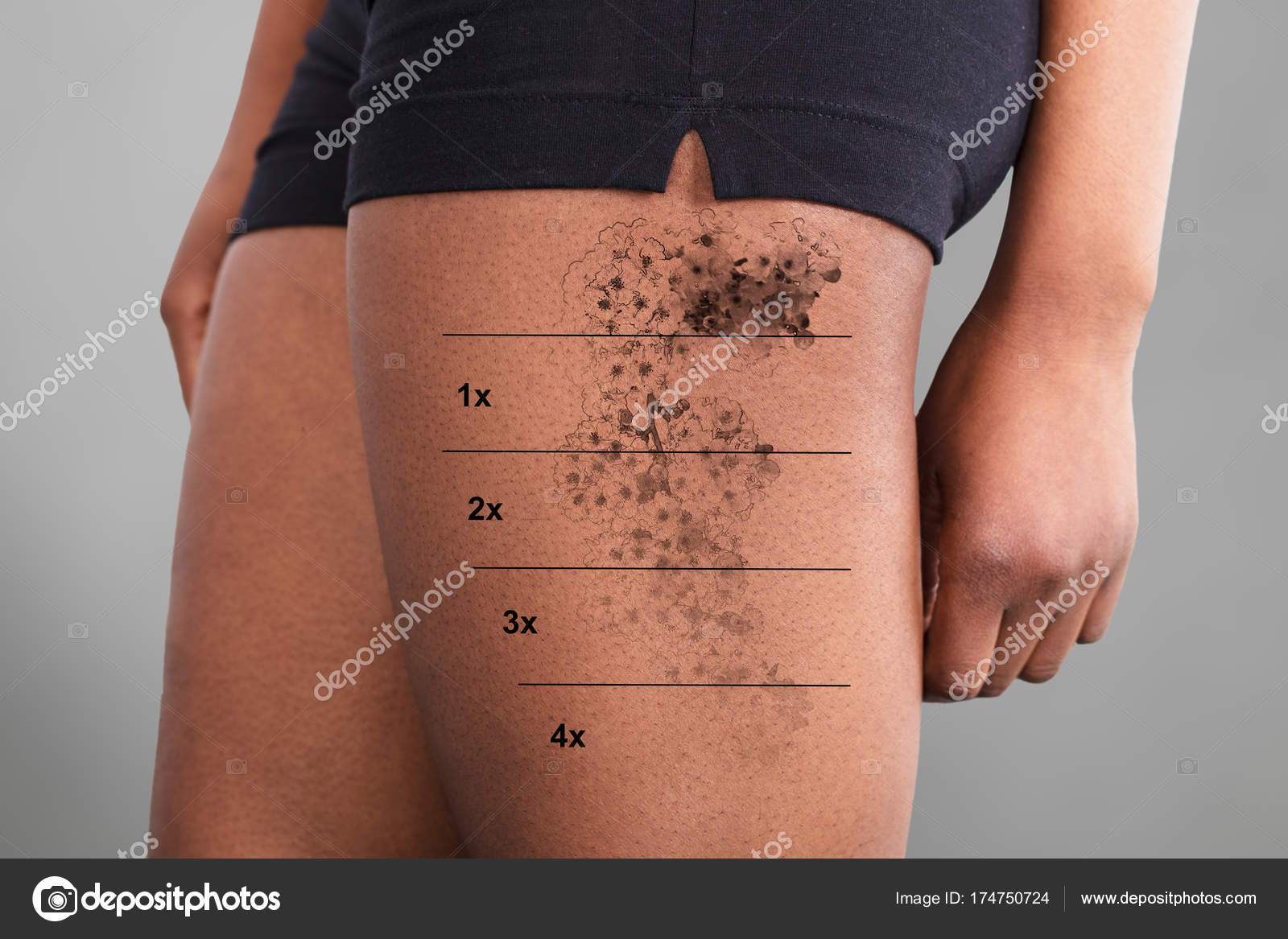 레이저 타투 제거 — 스톡 사진 © AndreyPopov #174750724, image size:1600x1167