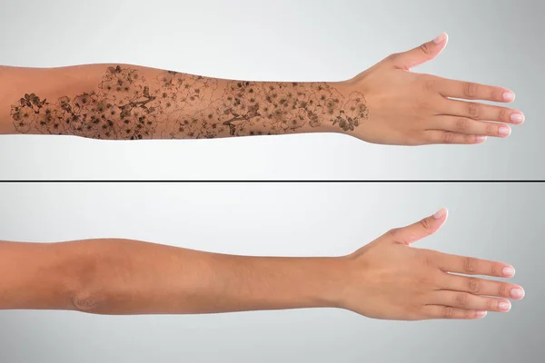Antes e depois da remoção da tatuagem — Fotografia de Stock